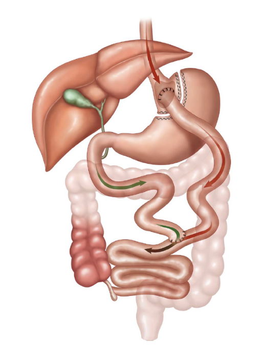 Anatomical diagram of a Roux-en-Y gastric bypass: a small stomach pouch with the small intestine rerouted in a Y shape