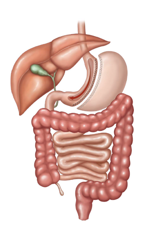 Anatomical diagram of a vertical sleeve gastrectomy: a thin, banana-shaped stomach after about 80% is removed